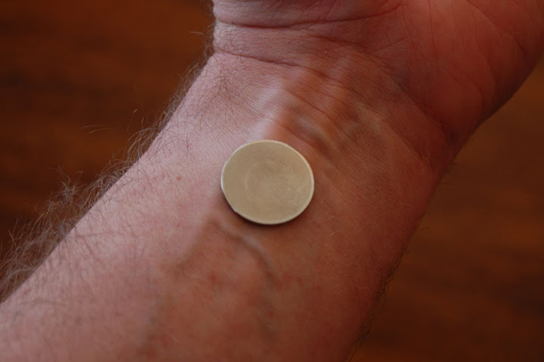 Dị ứng niken - Hình ảnh minh họa